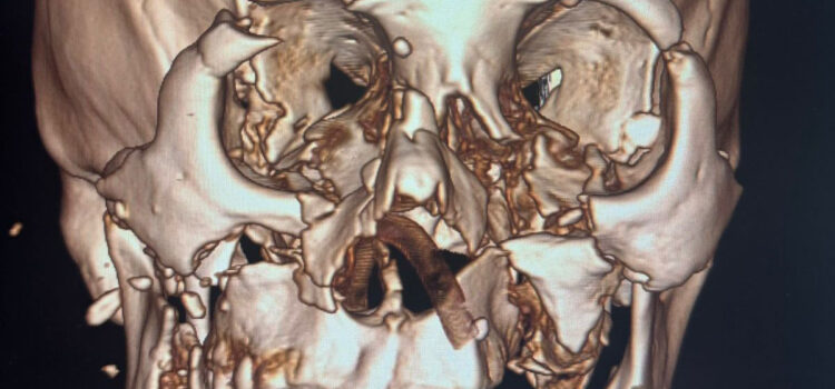 9 часов борьбы за лицо: врачи Алматинской области провели редкую операцию при тяжелой травме